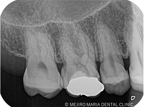 不可逆性歯髄炎の根管治療（抜髄）前のレントゲン写真｜東京 目白マリア歯科