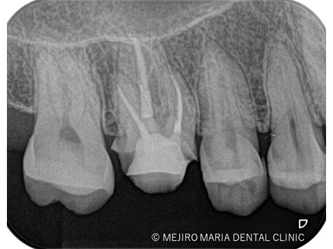 不可逆性歯髄炎の根管治療（抜髄）後のレントゲン写真｜東京 目白マリア歯科