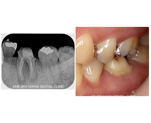 歯髄壊死の根管治療（抜髄）後のレントゲン写真｜東京 目白マリア歯科