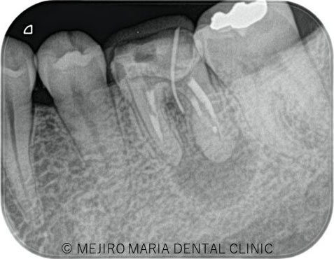 根管治療初診時のレントゲン写真｜東京 目白マリア歯科