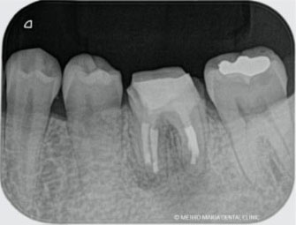 歯根端切除術直後のレントゲン写真｜東京 目白マリア歯科