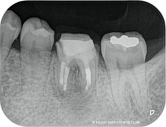 歯根端切除術3か月後のレントゲン写真｜東京 目白マリア歯科
