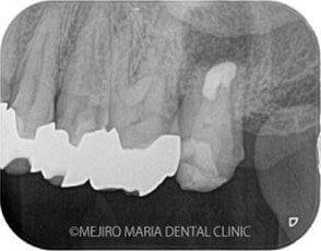 歯根端切除術（意図的再植術）直後のレントゲン