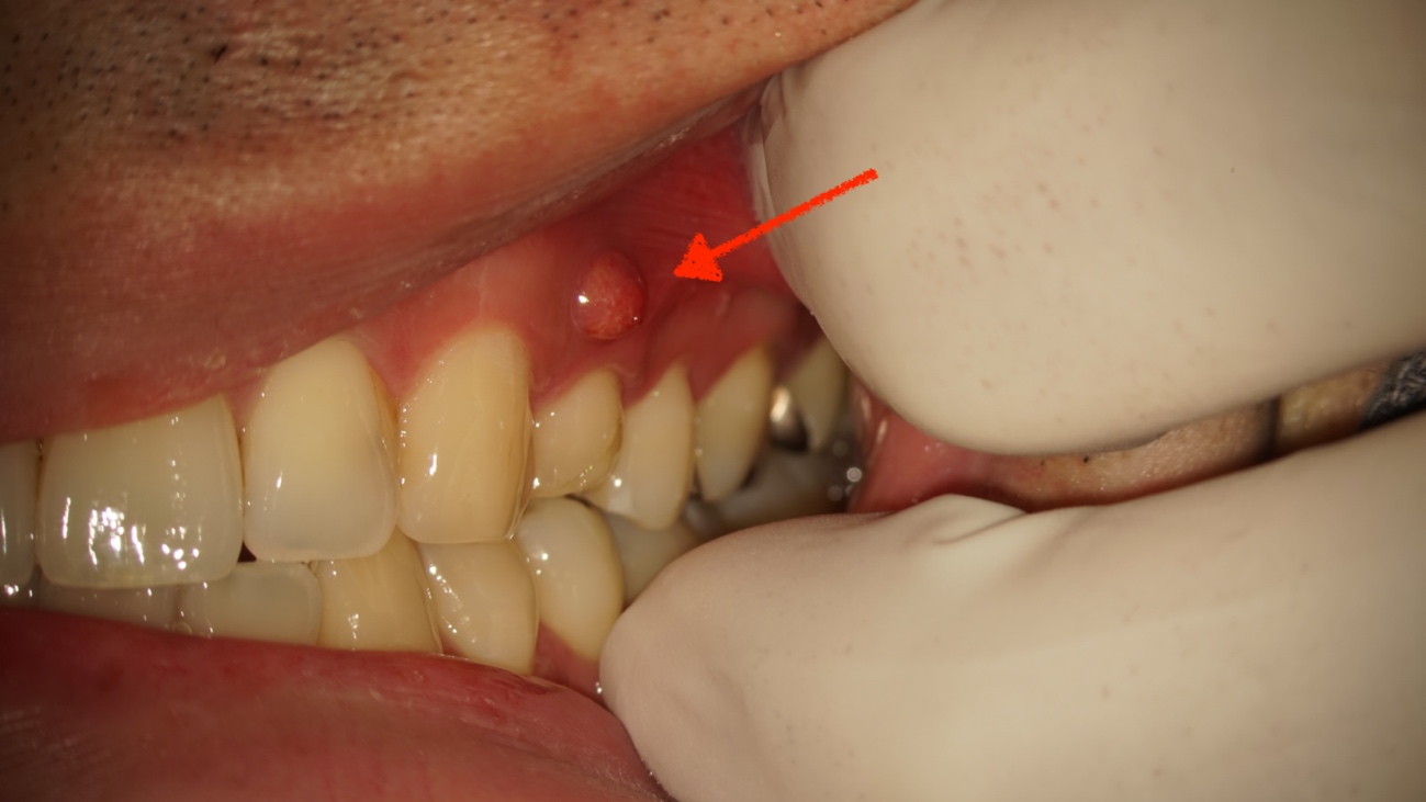 歯茎に瘻孔（ろうこう）というポツリと膨らみが出来た状態｜東京 目白の歯医者 目白マリア歯科