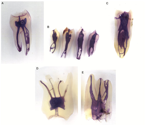 非常に複雑な形態に枝分かれした根管の様子｜東京 目白の歯医者 目白マリア歯科