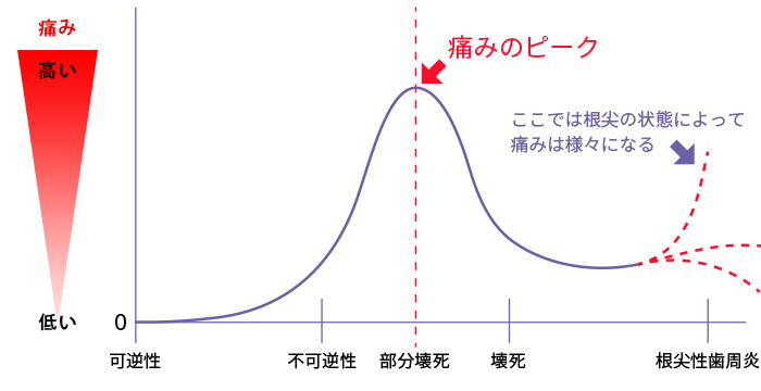 病状の変化と痛みのイメージ図｜東京 目白の歯医者 目白マリア歯科