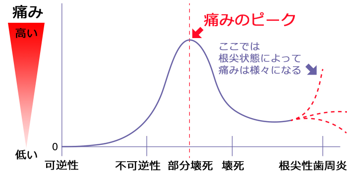 病状の変化と痛みのイメージ図｜東京 目白の歯医者 目白マリア歯科