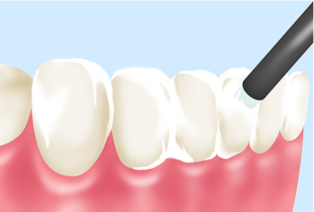 フッ素塗布で虫歯になりにくい歯に