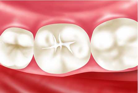 シーラントで汚れが溜まりにくい歯に