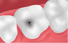 悪影響01永久歯が虫歯になる