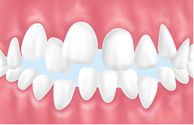 悪影響02歯並びが乱れる
