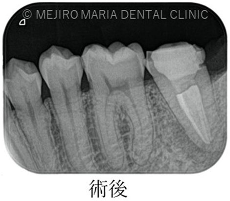再根管治療の治療後のレントゲン写真｜東京 目白マリア歯科