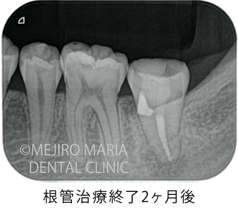 再根管治療穿孔修復の治療後のレントゲン写真｜東京 目白マリア歯科