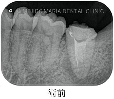 再根管治療の治療前のレントゲン写真｜東京 目白マリア歯科
