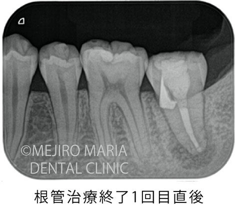 再根管治療 穿孔修復の治療前のレントゲン写真｜東京 目白マリア歯科