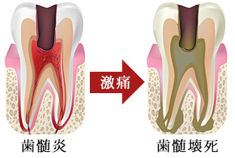 歯髄炎から歯髄壊死に移る時に激痛が生じる｜東京 目白の歯医者 目白マリア歯科