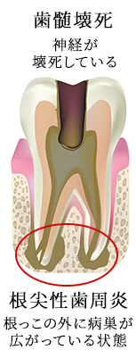 根管治療の成功率を下げる歯髄壊死にまで発展した状態｜東京 目白の歯医者 目白マリア歯科