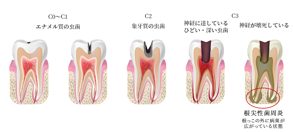 虫歯の進行｜東京 目白の歯医者 目白マリア歯科