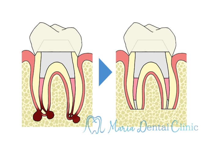 歯根端切除術のイラスト