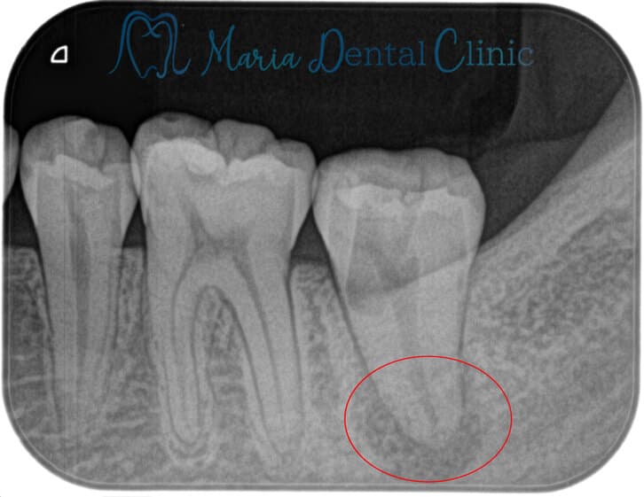 レントゲンの画像