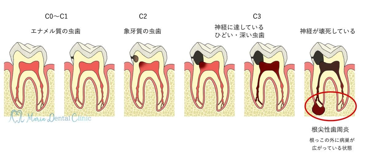 虫歯の進行