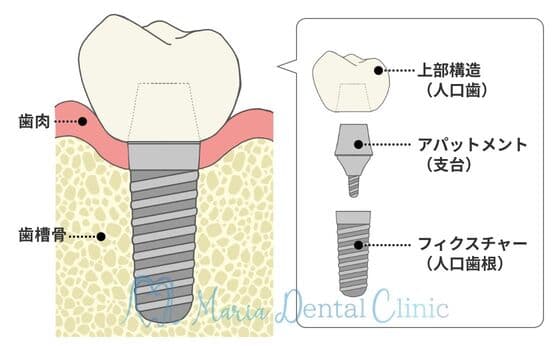 インプラントの構造の図