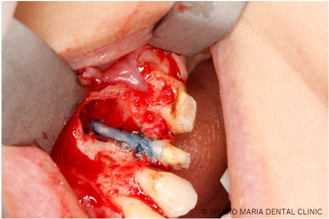 0720症例外科的根管治療「歯根端切除術」治療中の画像