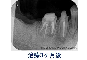0720症例外科的根管治療「歯根端切除術」治療後3ヶ月のレントゲン写真