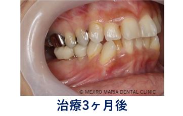 0720症例外科的根管治療「歯根端切除術」治療後3ヶ月の口腔内写真