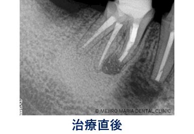 0720症例外科的根管治療「歯根端切除術」治療直後のレントゲン写真