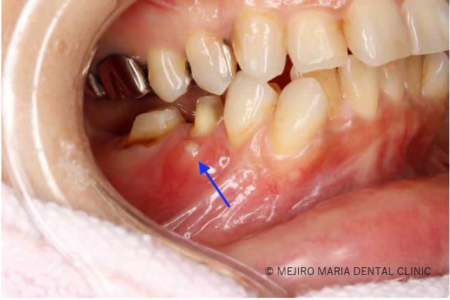 目白マリア歯科【症例】抜歯を宣告された歯を外科的根管治療「歯根端切除術」で保存_治療前_治療前の口腔内画像