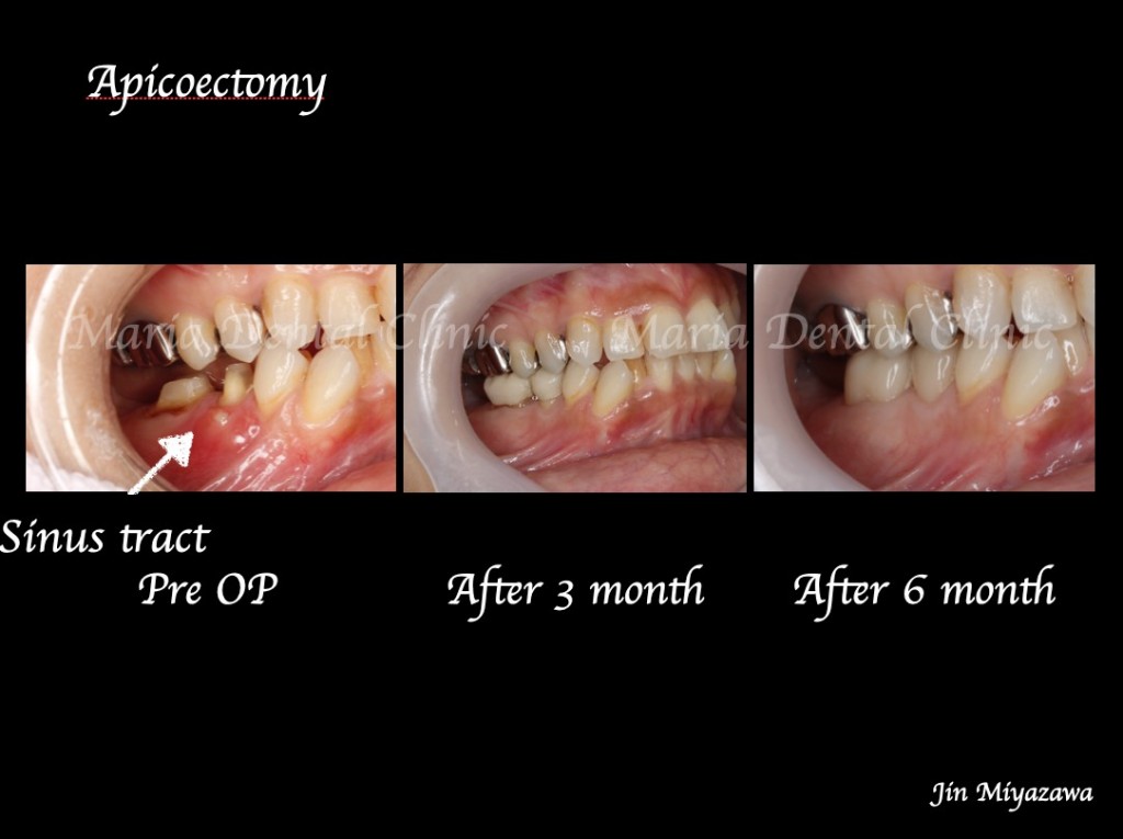 目白マリア歯科【症例】抜歯を宣告された歯を外科的根管治療「歯根端切除術」で保存_術前術後の口腔内写真の比較