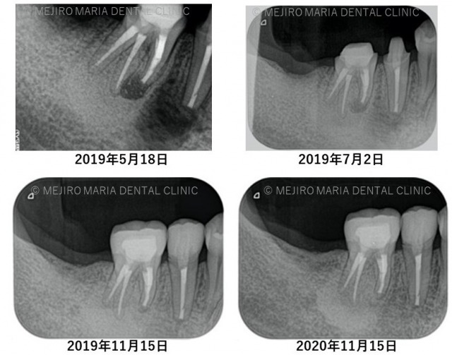 目白マリア歯科＿抜歯を宣告された歯を外科的根管治療「歯根端切除術」で保存した症例_1年目経過観察レントゲン画像比較