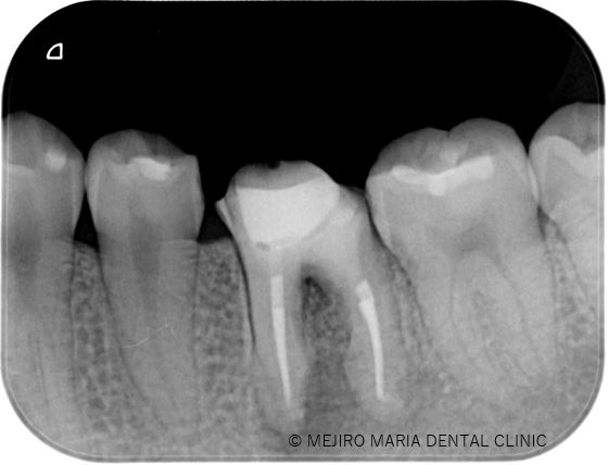 0807症例治療前目白マリア歯科精密根管治療_治療後