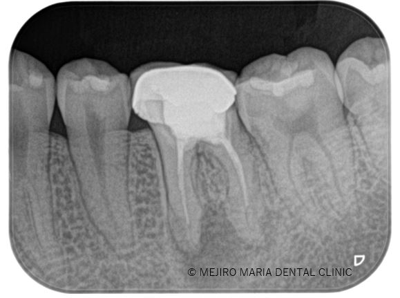 目白マリア歯科【症例】精密根管治療による治療期間の短縮_治療前_治療前のレントゲン画像
