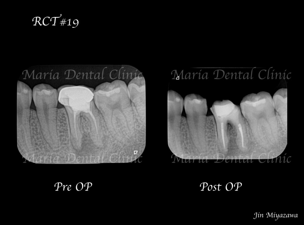 目白マリア歯科【症例】精密根管治療による治療期間の短縮_術前術後の比較レントゲン画像