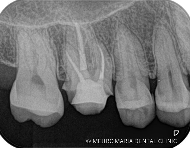 目白マリア歯科初回根管治療症例治療後20190917
