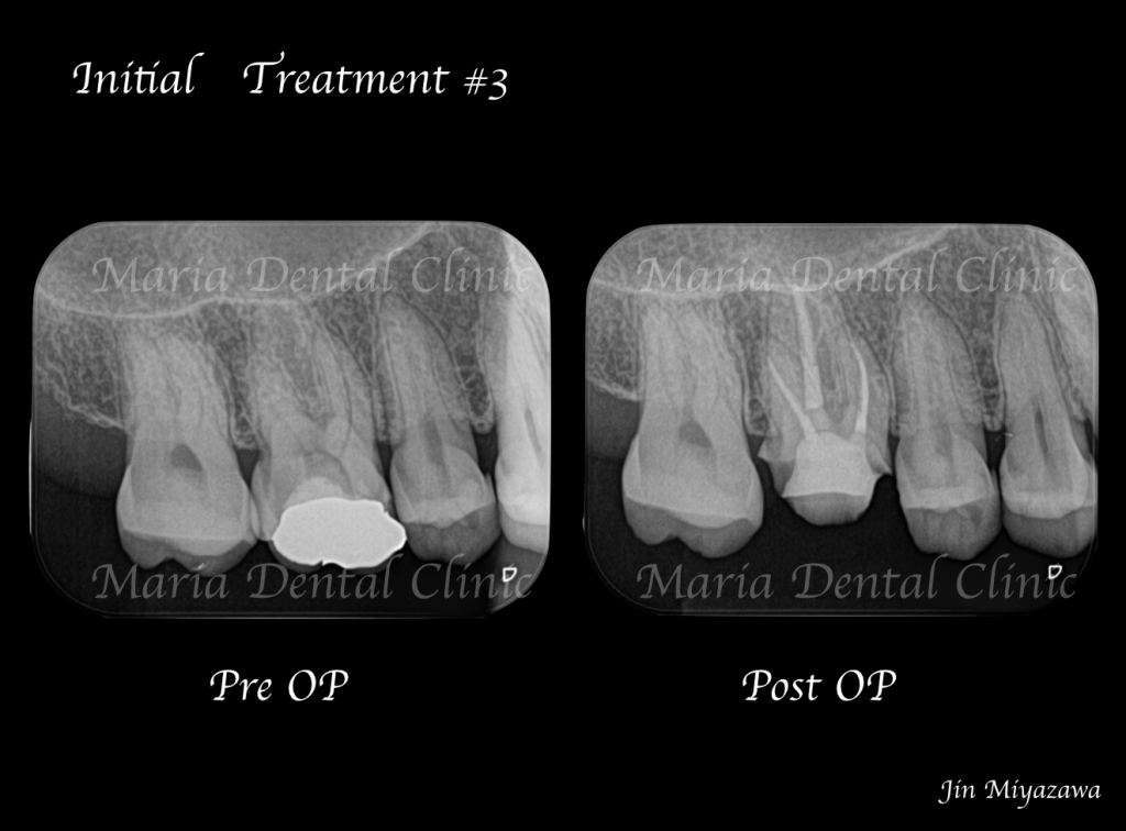 目白マリア歯科【症例】精密根管治療による抜髄処置（初回根管治療）｜歯の寿命を左右する初回根管治療_術前術後のレントゲン画像比較