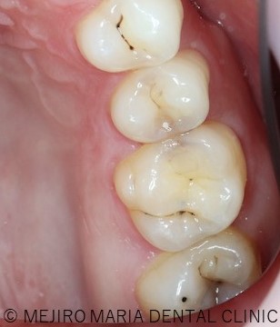 症例 無症状で進行するセラミック治療後の虫歯 目白マリア歯科 目白 下落合の歯医者