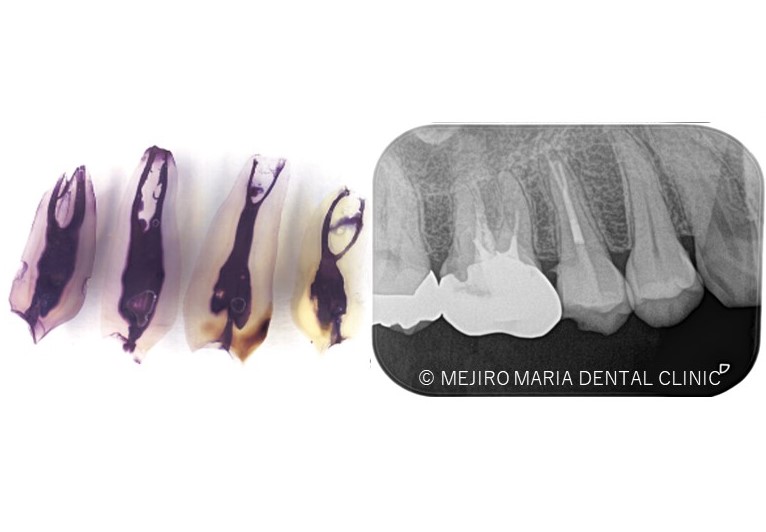 目白マリア歯科の根管の複雑さが分かる歯のレントゲン写真