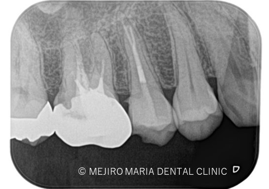 1011症例治療前目白マリア歯科精密根管治療_治療後２
