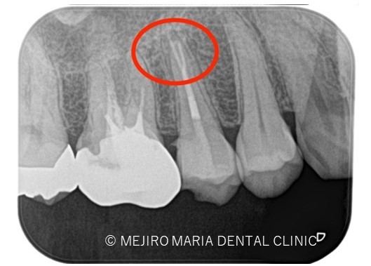 1011症例治療前目白マリア歯科精密根管治療_治療後３