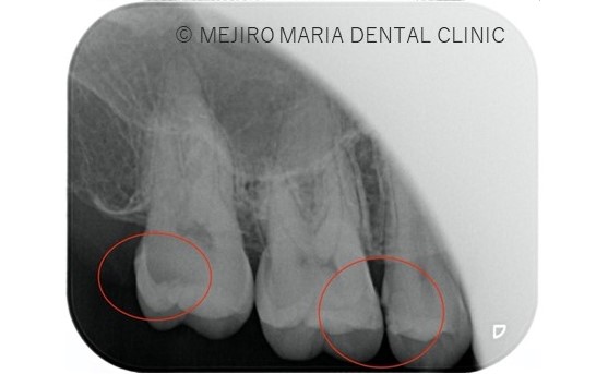 目白マリア歯科【症例】セラミック材料を使った修復処置・セラミック接着時の環境への配慮_治療前_虫歯箇所がわかるレントゲン画像