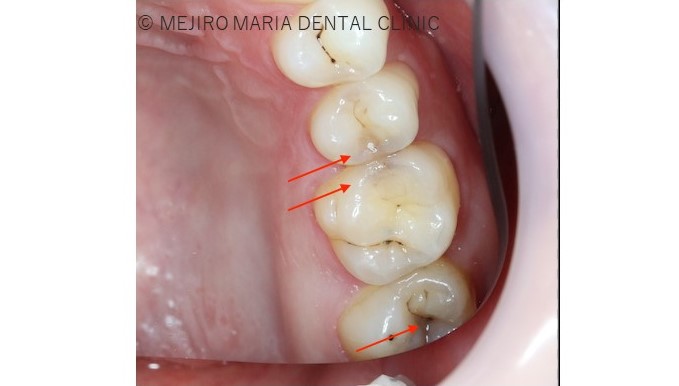 目白マリア歯科【症例】セラミック材料を使った修復処置・セラミック接着時の環境への配慮_治療前_虫歯箇所がわかる口腔内写真