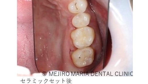 目白マリア歯科【症例】セラミック材料を使った修復処置・セラミック接着時の環境への配慮_治療後_セラミックセット後