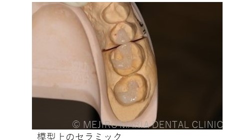 目白マリア歯科【症例】セラミック材料を使った修復処置・セラミック接着時の環境への配慮_治療後_模型上のセラミック