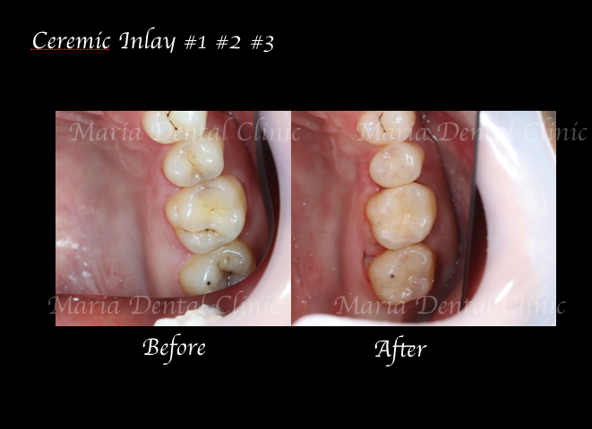 目白マリア歯科【症例】セラミック材料を使った修復処置・セラミック接着時の環境への配慮_術前術後のレントゲン画像比較