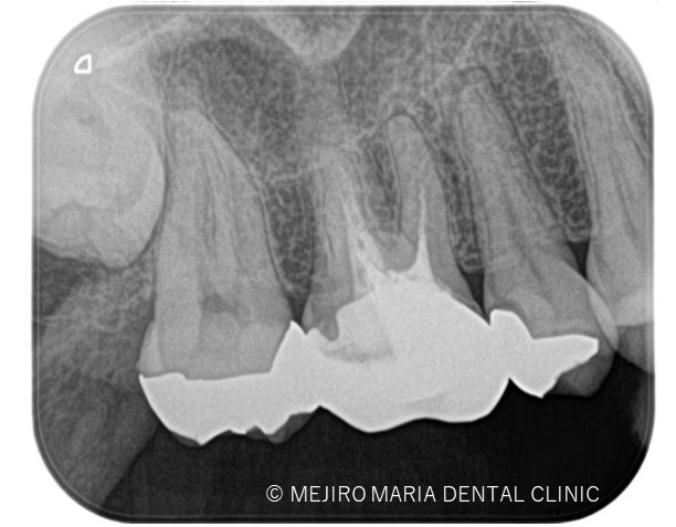 目白マリア歯科【症例】精密根管治療による複雑な根管形態へのアプローチ_治療前_レントゲン画像1