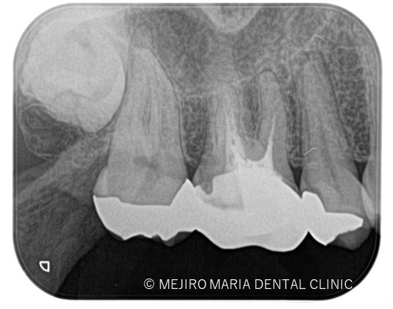 目白マリア歯科【症例】精密根管治療による複雑な根管形態へのアプローチ_治療前_レントゲン画像2