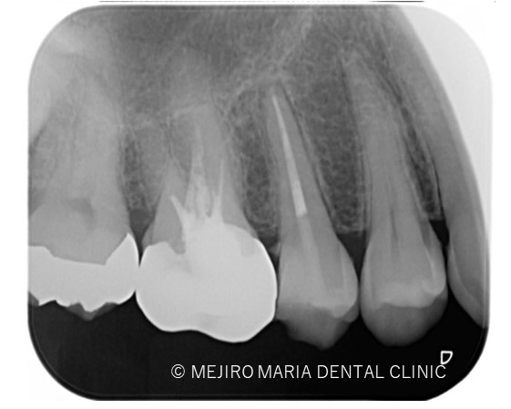 目白マリア歯科【症例】精密根管治療による複雑な根管形態へのアプローチ_治療後_レントゲン画像1